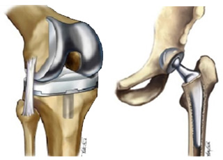 Joint Replacement Services in Aligarh